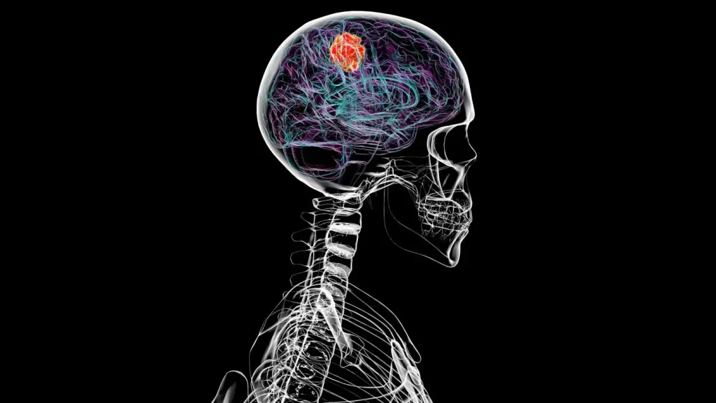 Brain cancer can dissolve parts of the skull