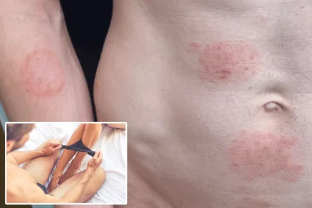 This sexually transmitted fungus causes ringworm in some very unfortunate places — and there’s an outbreak