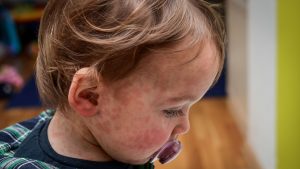 Measles has no treatments. Getting some may not be easy