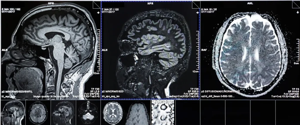 Depression May Be Early Warning Sign of Brain Changes, Study Finds