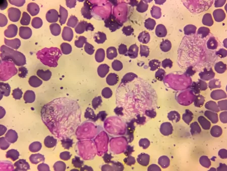1 in 8 Cancer Cases Worldwide Linked to Infections, Study Finds
